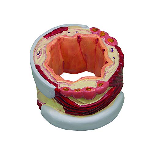 GPI Anatomicals 4-Piece Bronchus Model, Replica with Pathologies - style: Bronchus Model
