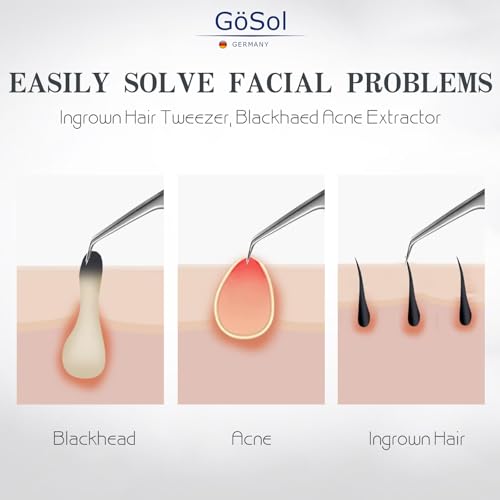 Pro Blackhead Tweezers, Precision Slant Tip for Blackhead Extraction - color: Black Leather Case