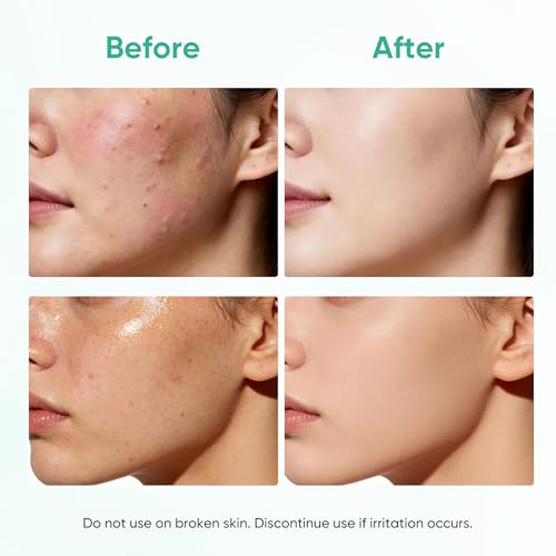 Acne Face Mask Skincare, Sheet Masks for Acne Prone, 10 Pack - color: Salicylic Acid Mask
